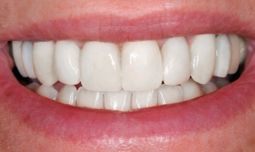 Teeth In a Day After Treatment