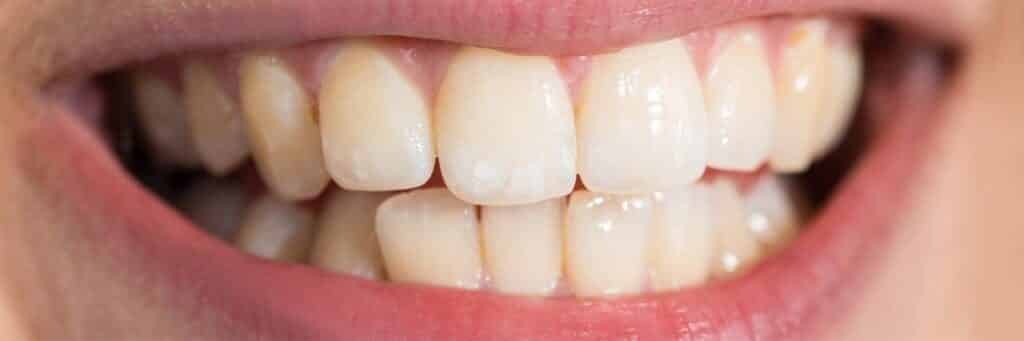 Before Teeth Whitening