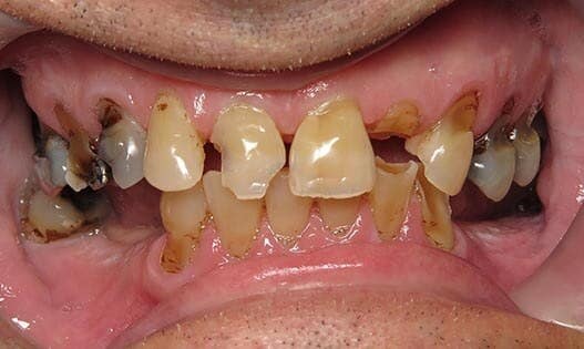 Teeth Restoration Macon GA