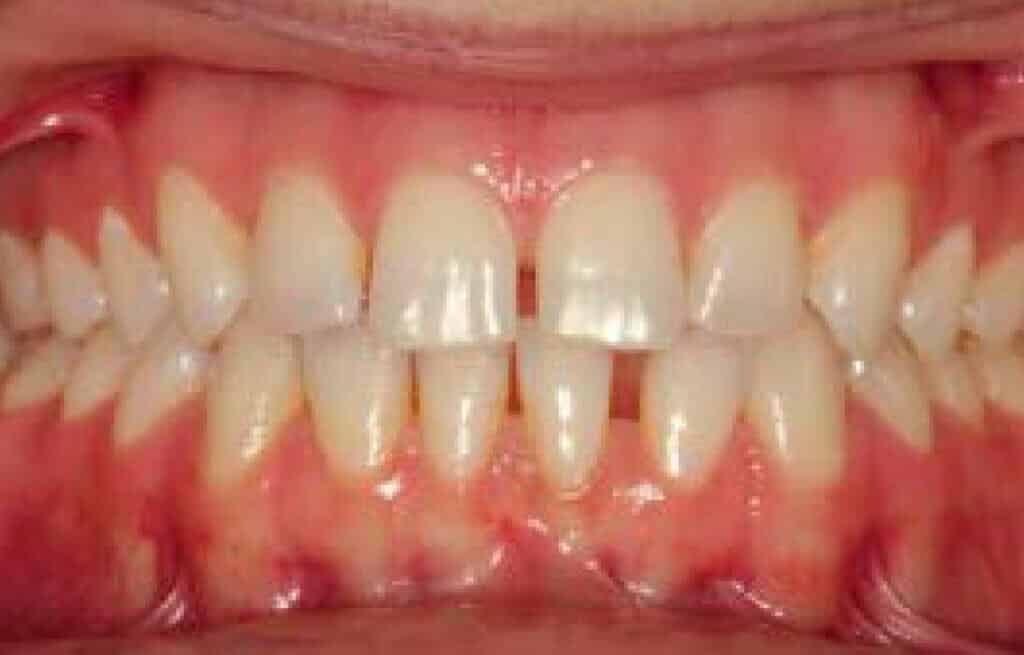 Tooth Repair Macon GA