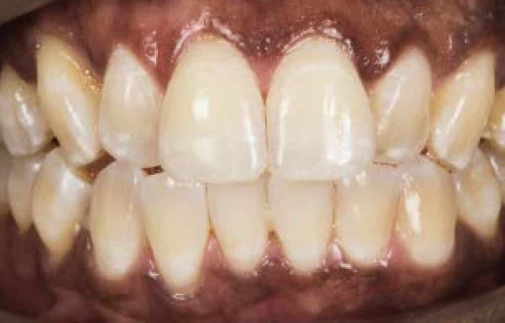 Stained Teeth Macon GA