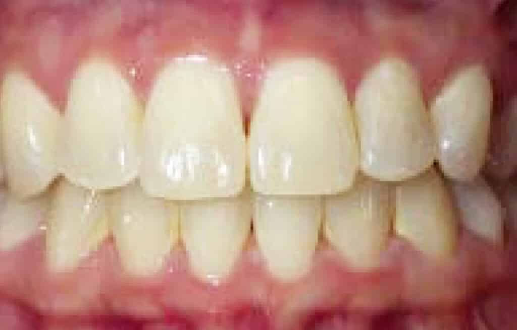 Teeth Whitening Macon GA