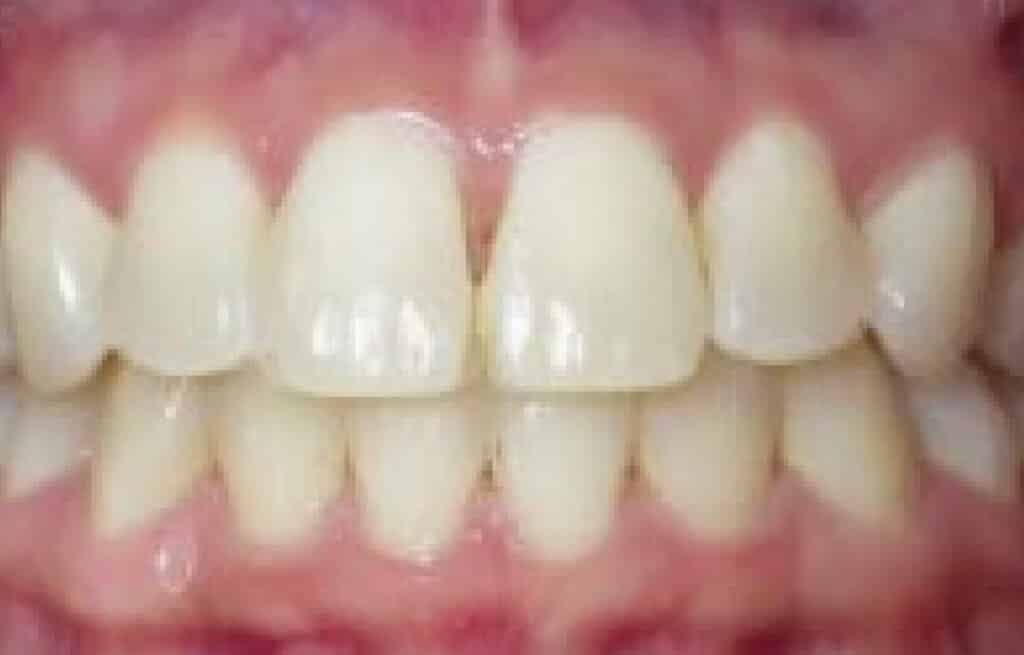 Fix Misaligned Teeth Macon GA